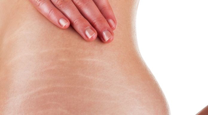 Treatment of Stretch Marks